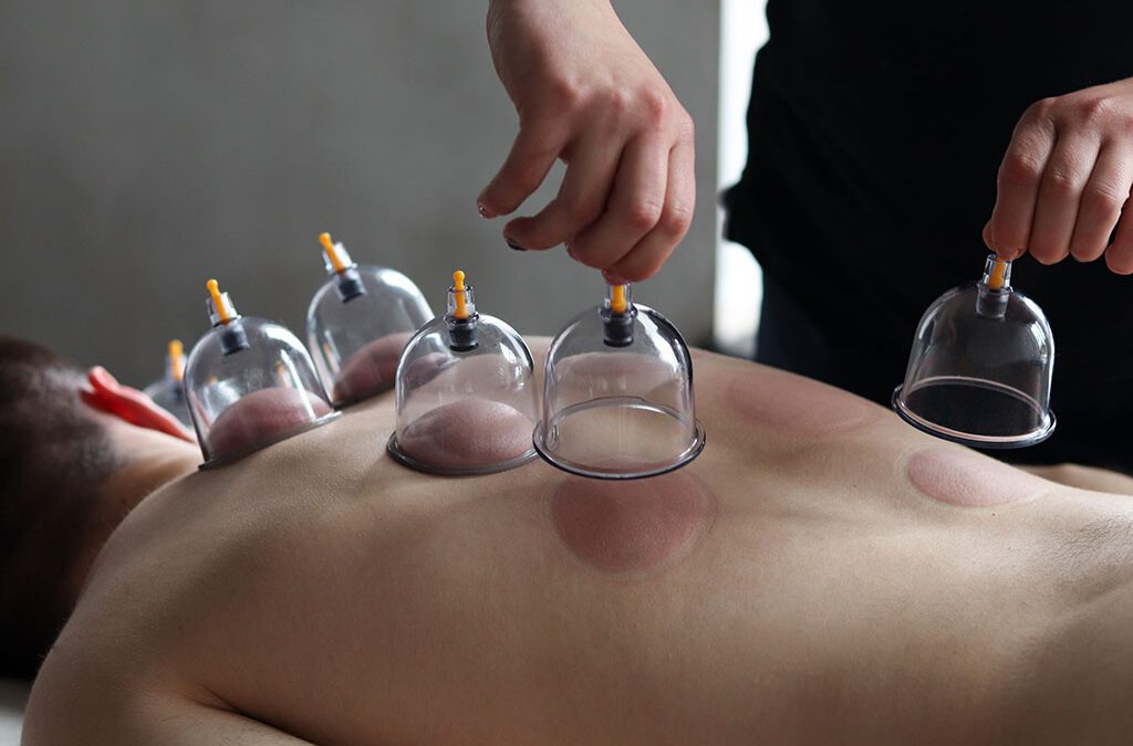 Cupping Therapy: A Natural Solution for Chronic Pain