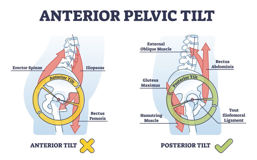Pelvic Tilt: The Hidden Cause of Lower Back Pain and How to Fix It