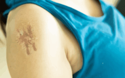 How Scar Tissue Affects Mobility & How Massage Can Help