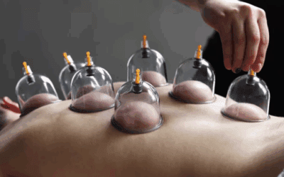 Does Cupping Therapy Help with Muscle Recovery & Performance?