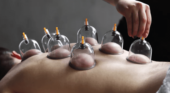 Does Cupping Therapy Help with Muscle Recovery & Performance?