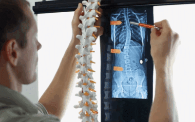 Massage for Scoliosis: What Works and What Doesn’t